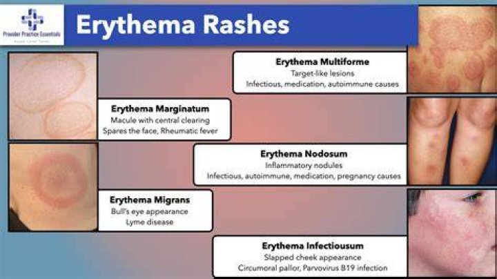 (A,B) Areas of mildly erythematous mucosa and multiple aphthous ulcers