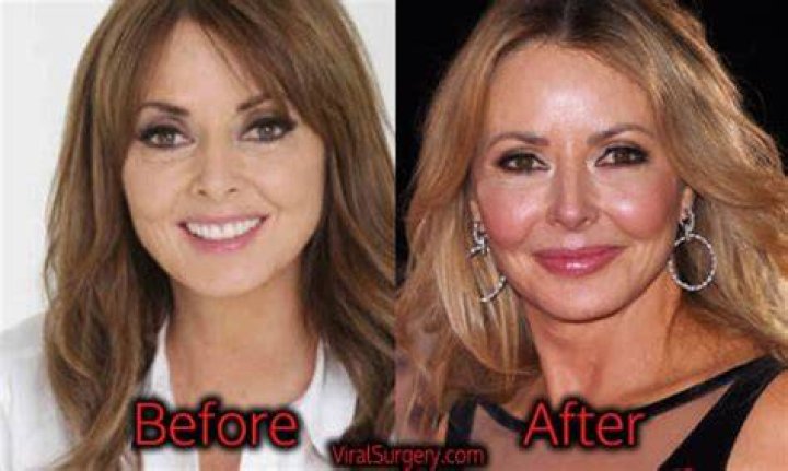 Carol Plastic Surgery Facelift, Botox Before and After Photos