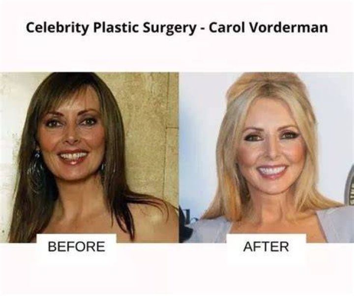 Carol Plastic Surgery With Before And After Photos