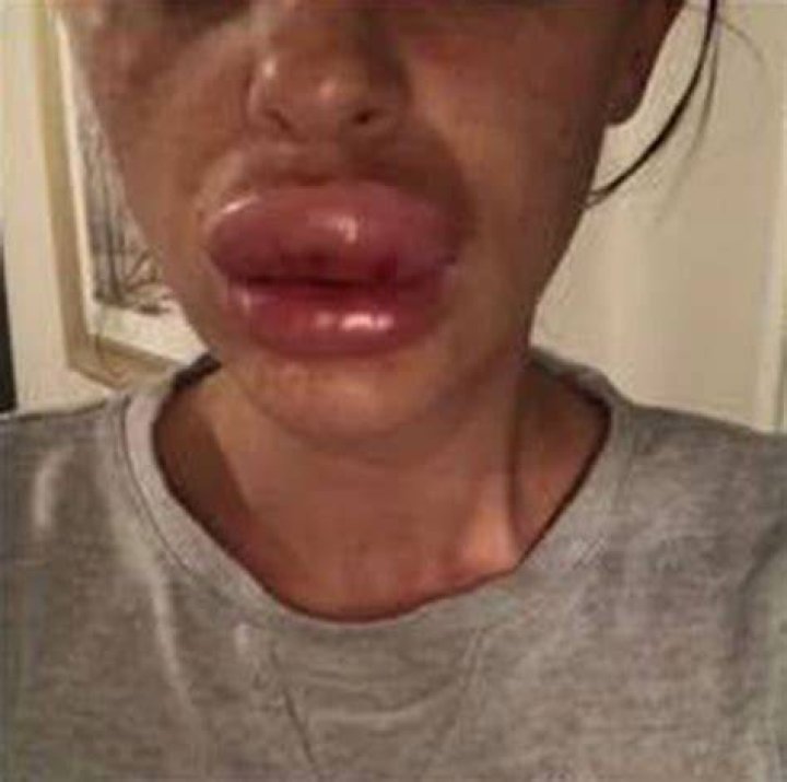 My lips ballooned to EIGHT TIMES their normal size after I had filler