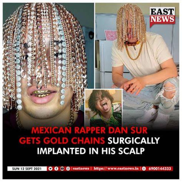 Rapper Dan Sur gets gold chains surgically implanted into scalp