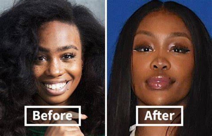 SZA Plastic Surgery. BBL, Before And After Pictures.